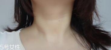 頸部除皺手術(shù)哪種最好？不同年齡針對治療