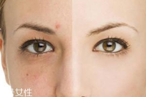 祛痘產(chǎn)品怎么選？先要分清痘印類型