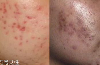 祛痘產(chǎn)品怎么選？先要分清痘印類型