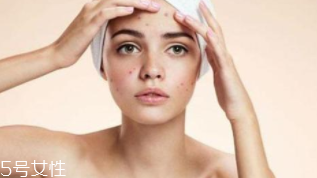 祛痘產(chǎn)品怎么選？先要分清痘印類型