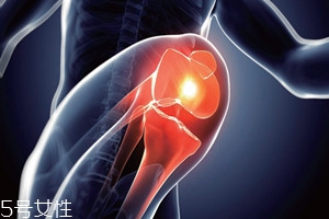 膝骨關節(jié)炎有什么癥狀 需注意5大癥狀