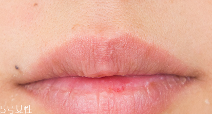 蘭芝唇膜吃進(jìn)去怎么辦？擁有水嫩嘴唇
