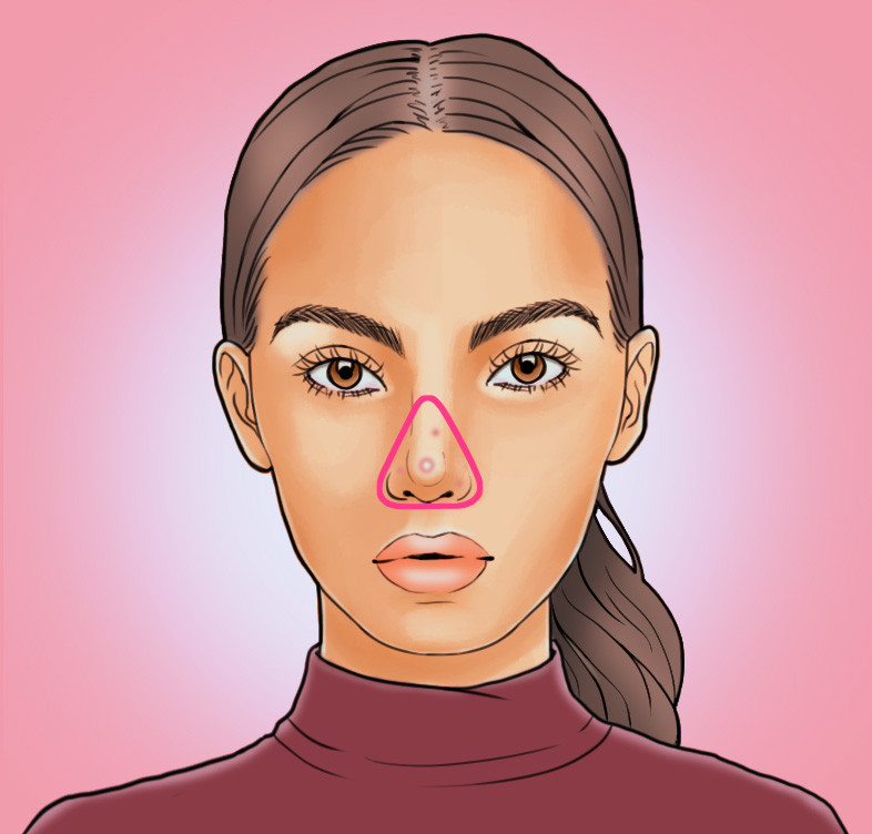 臉上長(zhǎng)痘痘位置原因圖解 各部位長(zhǎng)痘調(diào)理各不同 臉上長(zhǎng)痘痘位置原因圖解 各部位長(zhǎng)痘調(diào)理各不同