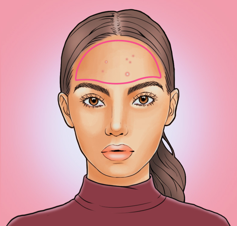 臉上長(zhǎng)痘痘位置原因圖解 各部位長(zhǎng)痘調(diào)理各不同 臉上長(zhǎng)痘痘位置原因圖解 各部位長(zhǎng)痘調(diào)理各不同