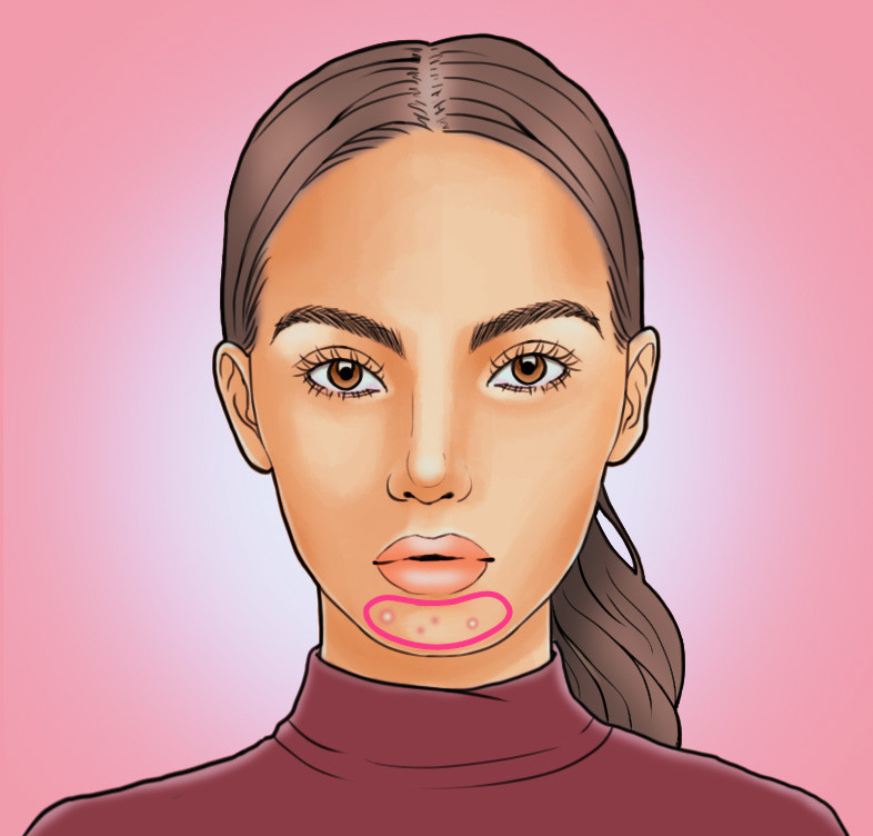 臉上長(zhǎng)痘痘位置原因圖解 各部位長(zhǎng)痘調(diào)理各不同 臉上長(zhǎng)痘痘位置原因圖解 各部位長(zhǎng)痘調(diào)理各不同