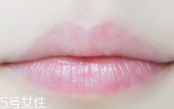 嘴唇干裂是一種病嗎？治療口角炎從改善習(xí)慣入手