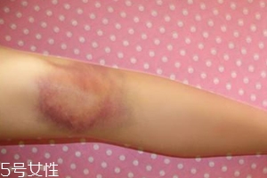 身體淤青怎么來(lái)的？不是磕碰那么簡(jiǎn)單