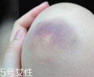 身體淤青怎么來(lái)的？不是磕碰那么簡(jiǎn)單