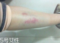 身體淤青怎么來(lái)的？不是磕碰那么簡(jiǎn)單