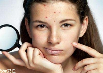 激光去痘印會(huì)留疤嗎？不規(guī)范操作肯定會(huì)有疤