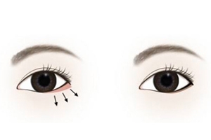 下眼瞼整形手術(shù)會留疤嗎？一般無明顯疤痕