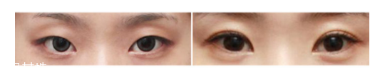 下眼瞼整形手術(shù)會(huì)留疤嗎？一般無(wú)明顯疤痕