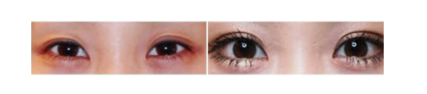 下眼瞼整形手術(shù)會(huì)留疤嗎？一般無(wú)明顯疤痕