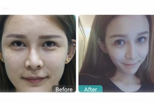 下瞼整形多久能恢復(fù)自然？半年時間