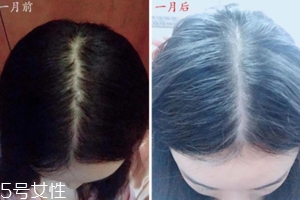 柳屋生發(fā)水有用嗎？一個月后長出新發(fā)