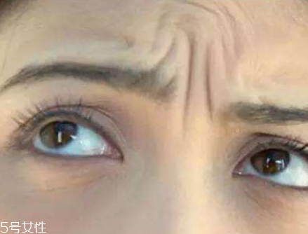 川字紋可以手術(shù)去除嗎？選擇手術(shù)需謹(jǐn)慎