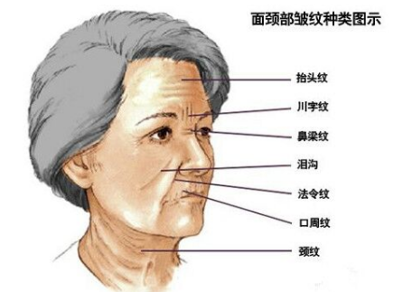 川字紋可以打玻尿酸嗎？不是最佳選擇