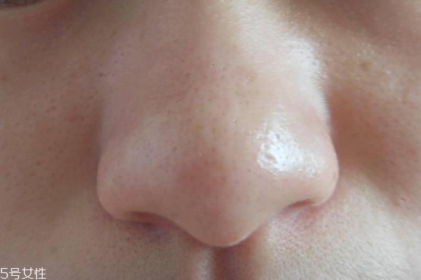 去黑頭用什么最有效？徒手?jǐn)D黑頭容易感染