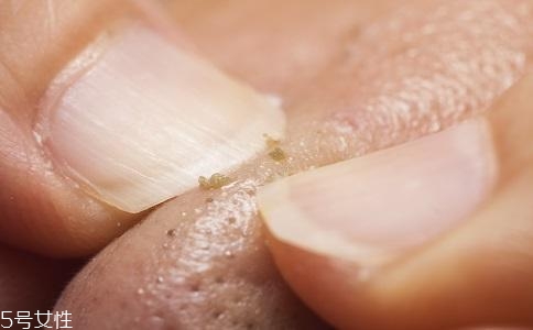 去黑頭用什么最有效？徒手?jǐn)D黑頭容易感染