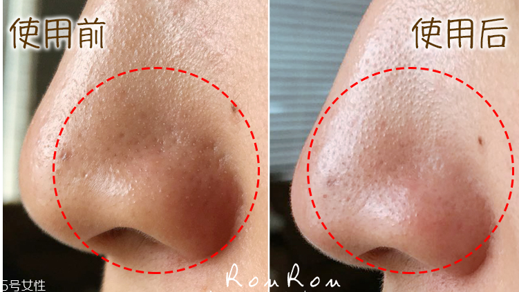 去黑頭步驟 去黑頭收縮毛孔小妙招 去黑頭步驟 去黑頭收縮毛孔小妙招