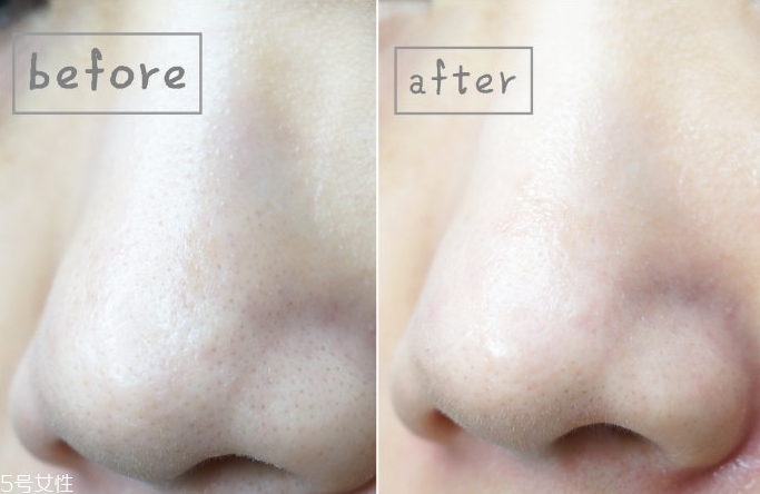 怎樣安全去除黑頭 安全去除黑頭的方法 怎樣安全去除黑頭 安全去除黑頭的方法