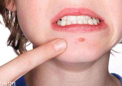 skinb5抗痘護(hù)膚片有效果嗎？