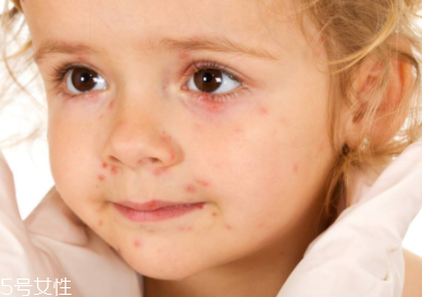 痘印顏色加深是怎么回事？補水還不夠