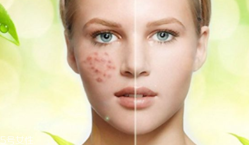 痘印顏色加深是怎么回事？補水還不夠