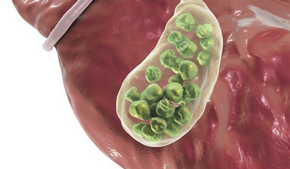 不吃早餐為什么會得膽結石 不吃早餐為什么會得膽結石