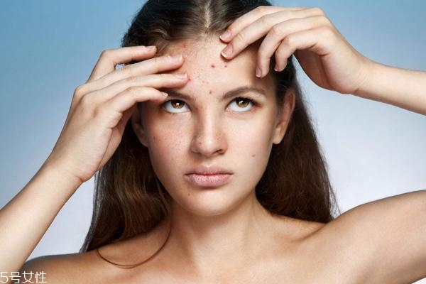 刷酸對(duì)痘痘有用嗎 這樣祛痘的妹紙痘痘都沒(méi)了 刷酸對(duì)痘痘有用嗎 這樣祛痘的妹紙痘痘都沒(méi)了