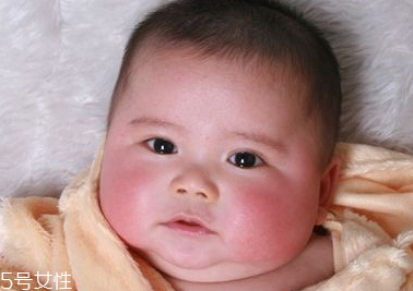 臉上有紅血絲的原因 這樣去除紅血絲 臉上有紅血絲的原因 這樣去除紅血絲