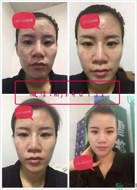 涵曦排毒針效果怎么樣？涵曦新品排毒針安全有副作用嗎？