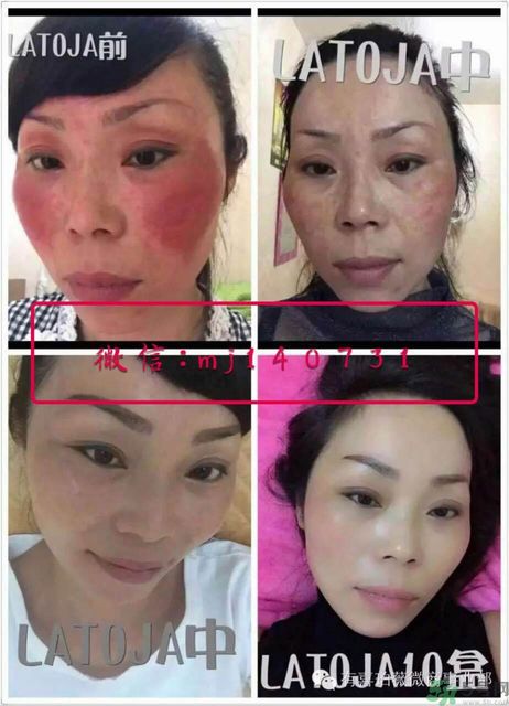 涵曦排毒針效果怎么樣？涵曦新品排毒針安全有副作用嗎？