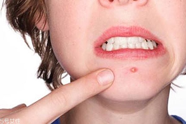 皮膚出油是因?yàn)轵x(chóng)嗎 臉上有螨蟲(chóng)的征兆 皮膚出油是因?yàn)轵x(chóng)嗎 臉上有螨蟲(chóng)的征兆