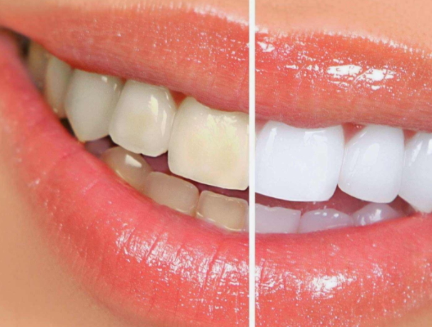 牙貼可以貼著睡覺(jué)嗎？牙貼可以過(guò)夜嗎