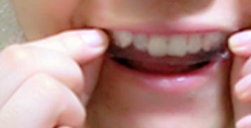 牙貼使用方法 牙貼使用注意事項 牙貼使用方法 牙貼使用注意事項