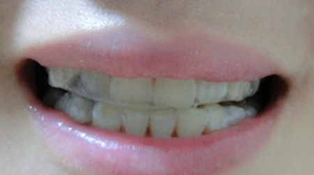 牙貼使用方法 牙貼使用注意事項 牙貼使用方法 牙貼使用注意事項