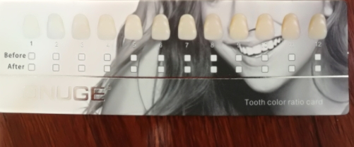 牙貼貼多久取下 牙貼貼多長時間 牙貼貼多久取下 牙貼貼多長時間