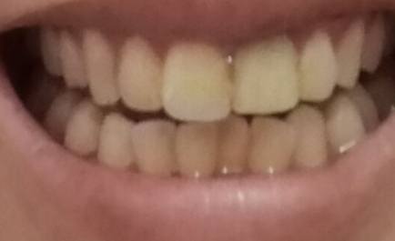 牙貼貼多久取下 牙貼貼多長時間 牙貼貼多久取下 牙貼貼多長時間