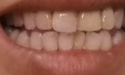 牙貼貼多久取下 牙貼貼多長時間 牙貼貼多久取下 牙貼貼多長時間