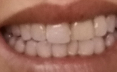 牙貼貼多久取下 牙貼貼多長時間 牙貼貼多久取下 牙貼貼多長時間