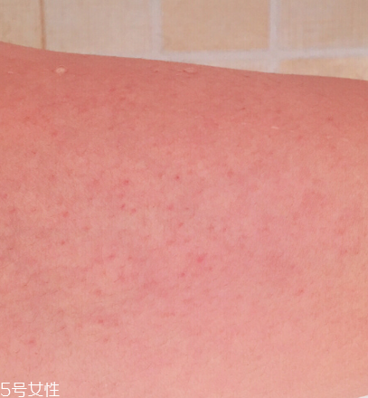 怎么去除雞皮膚 跟你的雞皮膚說再見 怎么去除雞皮膚 跟你的雞皮膚說再見