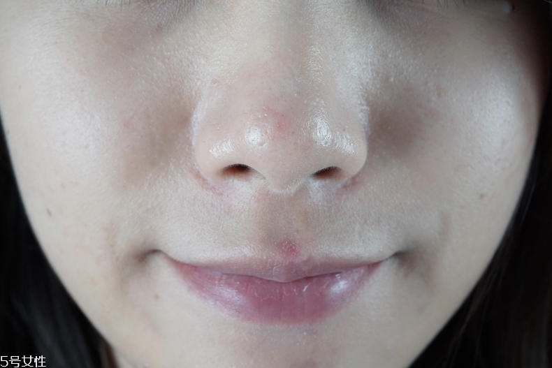 泊舒清痘霜有用嗎 泊舒清痘能力實測 泊舒清痘霜有用嗎 泊舒清痘能力實測