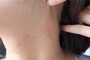 脖子長(zhǎng)痘痘怎么辦 教你脖子護(hù)理方法 脖子長(zhǎng)痘痘怎么辦 教你脖子護(hù)理方法