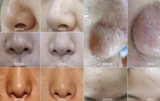 弄完小氣泡多久可以化妝？小氣泡注意事項