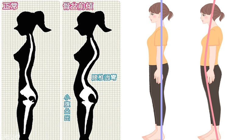 骨盆前傾如何矯正 骨盆前傾矯正動(dòng)作圖解 骨盆前傾如何矯正 骨盆前傾矯正動(dòng)作圖解