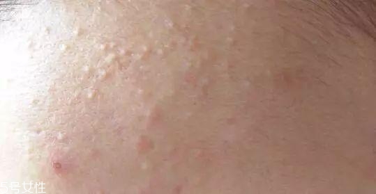 刷酸時要注意什么 刷酸去閉口操作指南 刷酸時要注意什么 刷酸去閉口操作指南