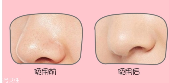 yoii黑頭儀怎么用？yoii黑頭儀怎么充電