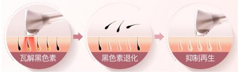 彩光脫毛安全嗎 彩光脫毛能永久脫毛嗎 彩光脫毛安全嗎 彩光脫毛能永久脫毛嗎