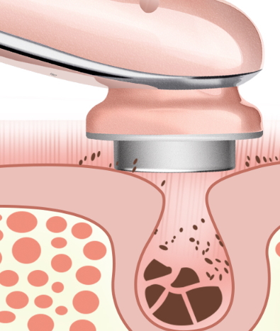 導(dǎo)出儀對皮膚的傷害 導(dǎo)出儀的副作用 導(dǎo)出儀對皮膚的傷害 導(dǎo)出儀的副作用
